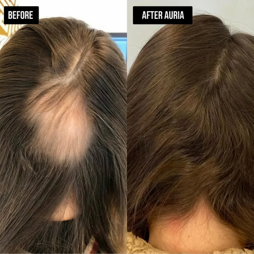 Auria Hair Regrowth System