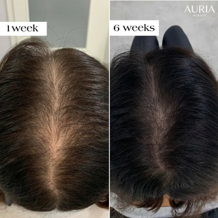 Auria Hair Regrowth System